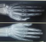 Рентген на костный возраст фото 1