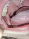 Лейкоплакия языка, кровь фото 1