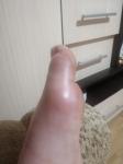 Боль в Косте на большом пальце на ноге фото 1