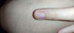 Коричневое пятно на ногте - меланома? фото 1