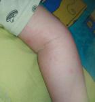 Сыпь на внутренней стороне руки у ребенка фото 1