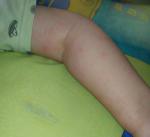 Сыпь на внутренней стороне руки у ребенка фото 2