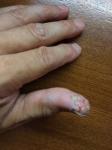 Трескается кожа большого пальца руки. Каков диагноз и лечение? фото 3