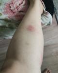 Первый раз аллергия от укусов насекомых фото 4