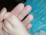 Диформация большого пальца ноги у ребенка фото 3
