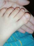 Диформация большого пальца ноги у ребенка фото 2