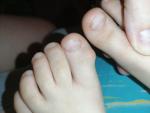 Диформация большого пальца ноги у ребенка фото 1