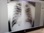 Рентгенограмма лёгких фото 1