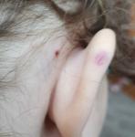 Прививка от бешенства ребенкк фото 1
