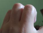 Ровный ряд пузырьков на коже пальца руки фото 1