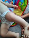Высыпания на коленке у ребёнка 1 год фото 1