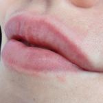 Сыпь на губах 5 месяцев фото 4