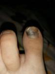 Травма ногтя фото 2