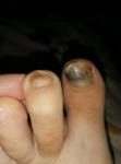 Травма ногтя фото 1