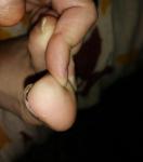 Травма ногтя фото 3