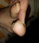 Травма ногтя фото 4
