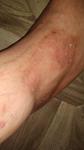 Проблемы с кожей на ноге фото 1