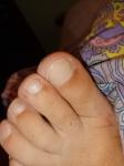 Коричневое пятно на пальце ноги фото 3