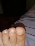 Коричневое пятно на пальце ноги фото 4