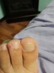 Коричневое пятно на пальце ноги фото 5