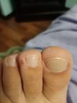 Коричневое пятно на пальце ноги фото 1