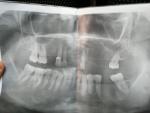 Зуб и гайморит фото 1