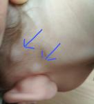 Шишки за ухом у ребенка фото 1