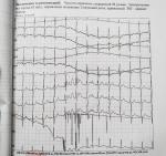 Помехи на ЭКГ фото 1