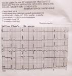 Нарушение внутрижелудочковой проводимости во всех отв фото 1