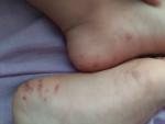 Уточните диагноз для определения лечения высыпаний на стопах ног фото 2