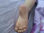 Уточните диагноз для определения лечения высыпаний на стопах ног фото 1