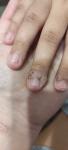 Чем вылечить кожу вокруг ногтей? фото 1
