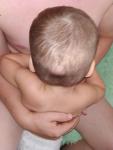Мягкая Шишка на голове у ребенка фото 1