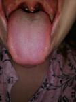 Красная сыпь на языке и за верхней губой фото 4