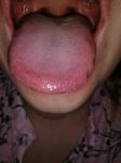 Красная сыпь на языке и за верхней губой фото 3