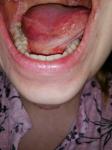 Красная сыпь на языке и за верхней губой фото 2