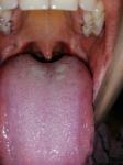 Красная сыпь на языке и за верхней губой фото 1