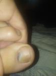 Фиолетово-белесое пятно на ногте фото 3