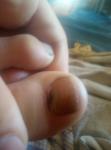 Фиолетово-белесое пятно на ногте фото 2