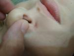 Трещины у носа у ребенка фото 2