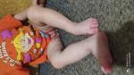 Волдыри и прищи почти везде у ребенка 1.4 месяца фото 3
