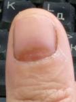 Коричневое пятно ногтя фото 1