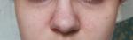 Трещины в уголках губ, шелушение у носа, сыпь на лбу фото 1