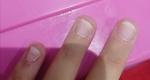 Псориаз ногтей или ониходистрофия фото 1