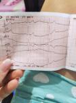 ЭКГ после артрита и сильной аллергии, расшифровать фото 4