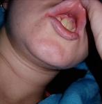 Повреждение губы фото 1