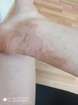 Раздражение, шелушение кожи, увеличение красноты на ноге фото 1