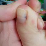 Тёмное пятно на ногте ноги фото 1