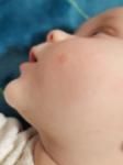 Красное пятно у ребенка на щеке фото 1
