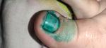 Воспаление кожи у ногтя большого пальца ноги фото 1